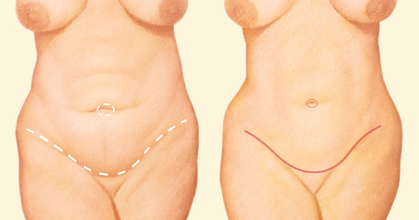 tummy tuck incision lines diagram
