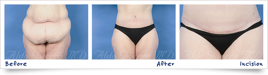 before and after photo of tummy tuck with dermabond
