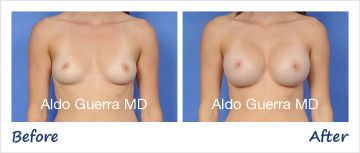Before and After MemoryGel Breast Implant