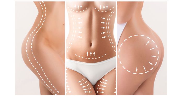 liposuction surgery markings