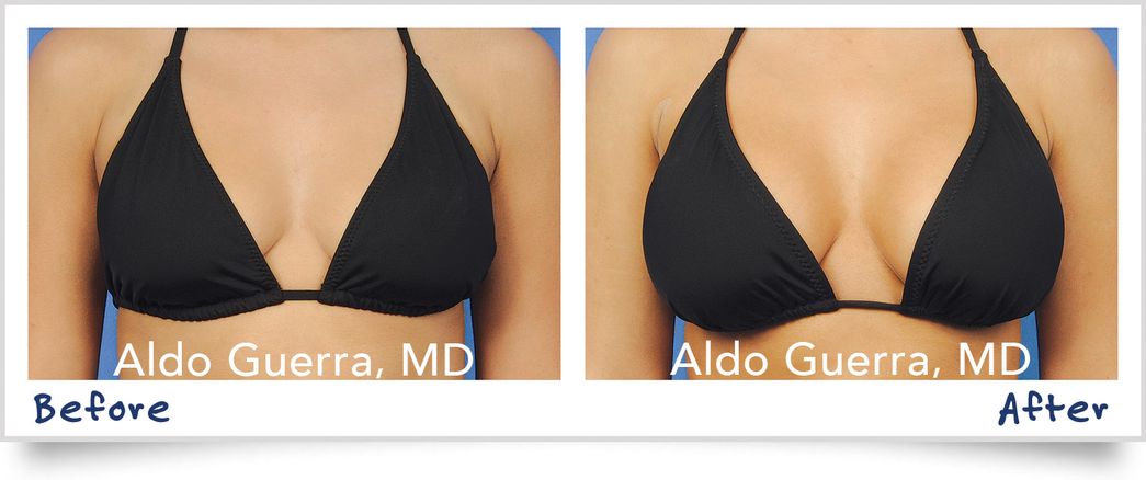 All I Want for the Holidays: A Guide to Breast Anatomy Before Surgery