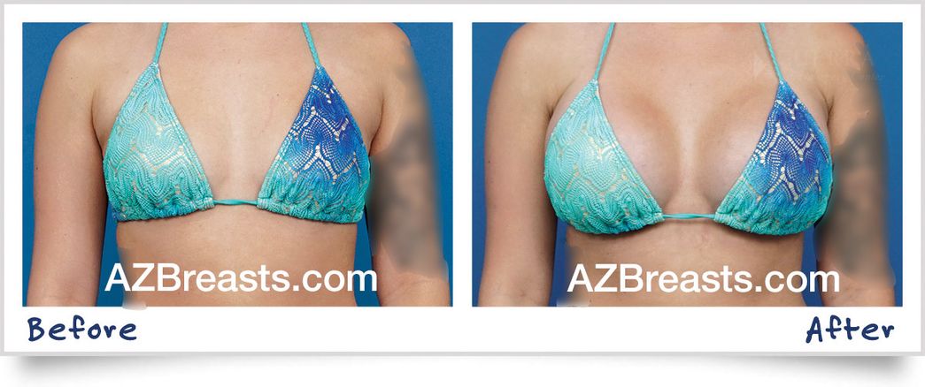 All I Want for the Holidays: A Guide to Breast Augmentation Anatomy Before Surgery