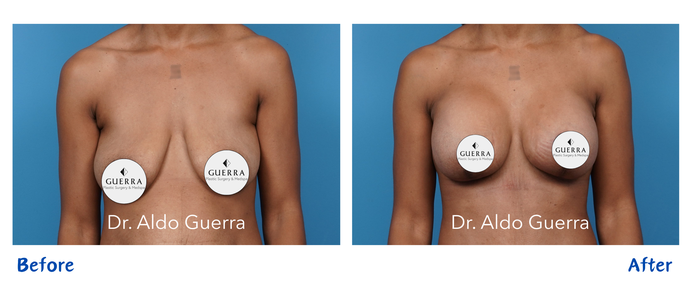 breast lift before and after photo