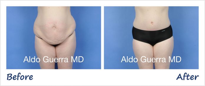 before and after photo tummy tuck