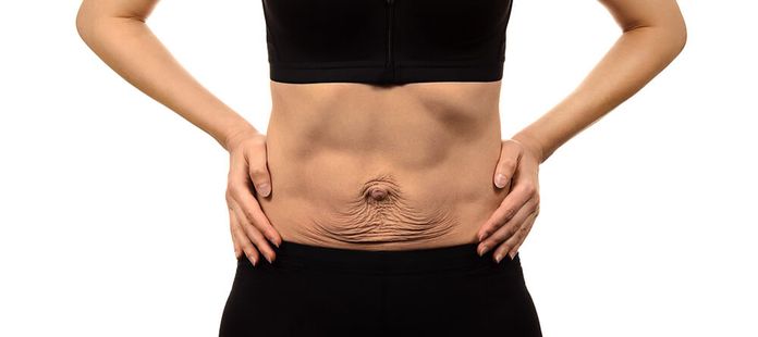 diastasis recti