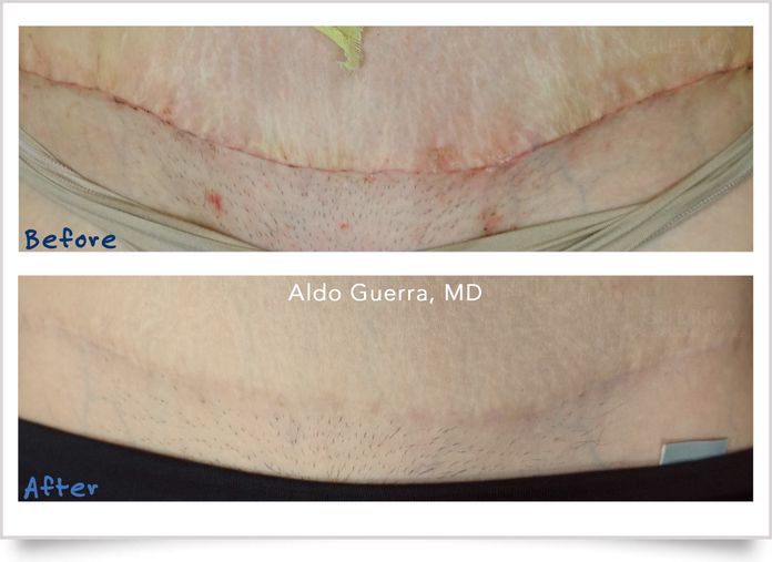 tummy tuck incision treated with embrace tummy tuck treated with embrace