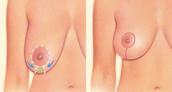 Vertical Breast Lift incision diagram