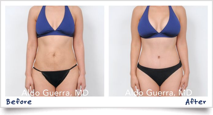 mommy makeover before and after photo