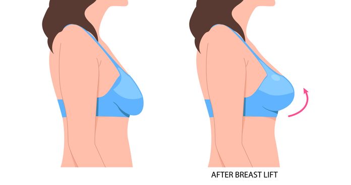breast lift diagram
