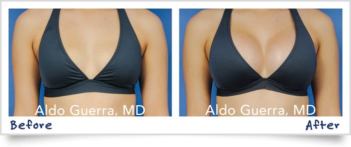 before after breast augmentation bikini
