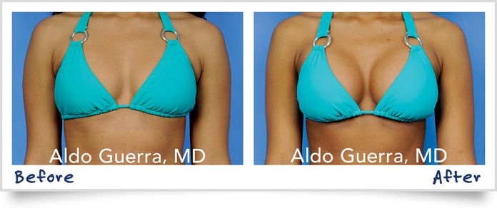 breast augmentation before and after bikini photo