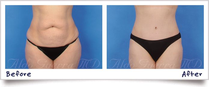 Tummy Tuck Results by Aldo Guerra