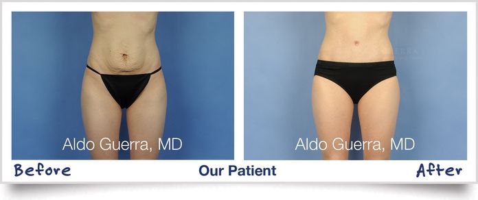 tummy tuck before and after photo