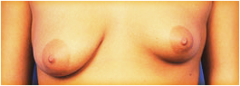 asymmetrical breasts