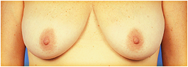 saggy breasts