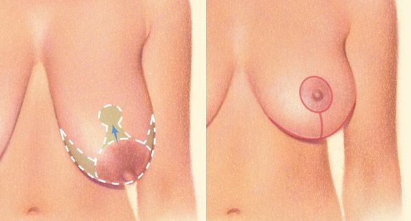 anchor pattern breast lift diagram