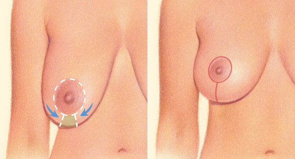 Wise pattern incision diagram