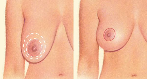 Periareolar incision diagram