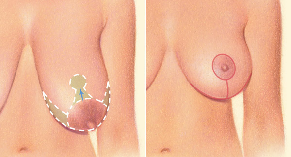 Wise pattern incision diagram