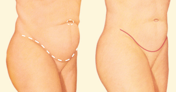 tummy tuck incision lines diagram