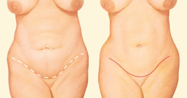 tummy tuck suture lines diagram