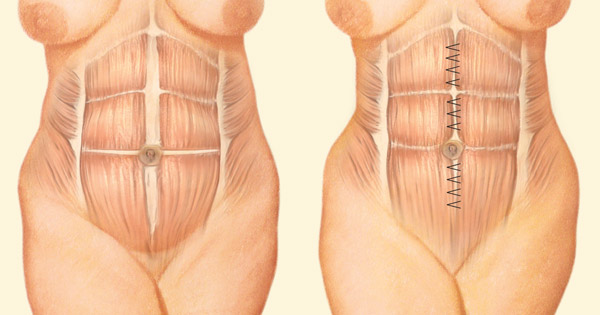 tummy tuck sutures illustration