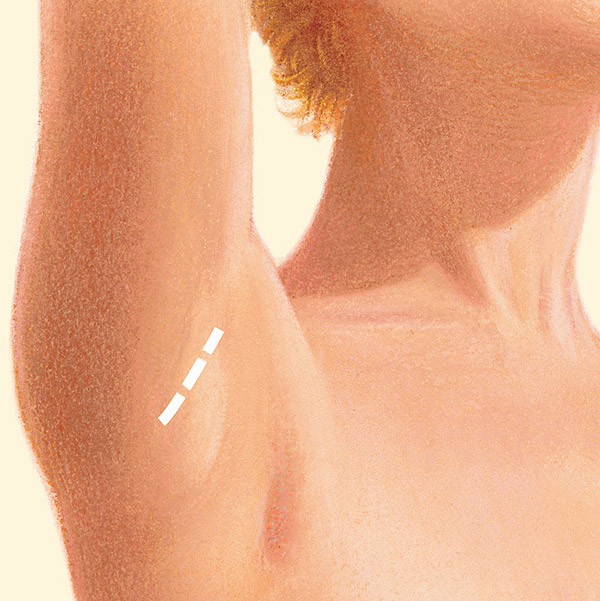 breast armpit incision diagram