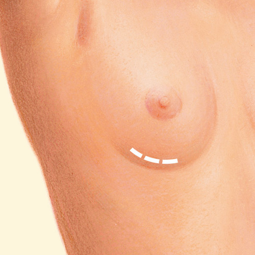 breast crease incision diagram