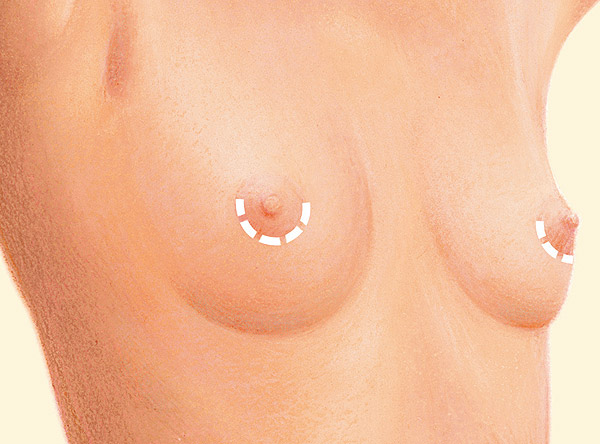breast nipple incision diagram