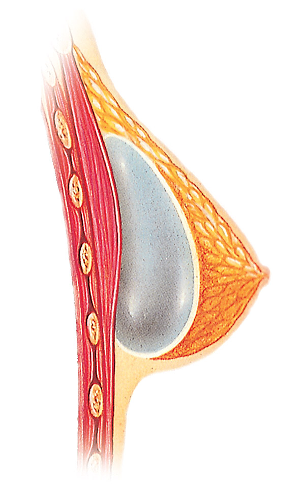 breast implant placement diagram