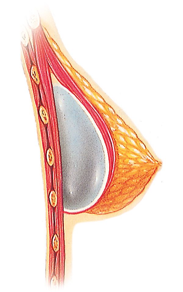 Diagram of breast implant placed under the muscle