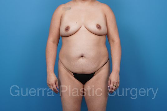 Before Photo Tummy Tuck with Breast Augmentation