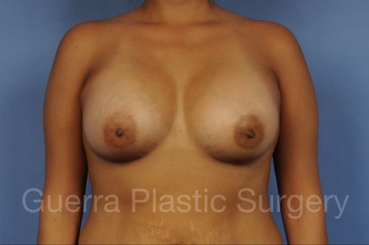 prev Case #1004005 After