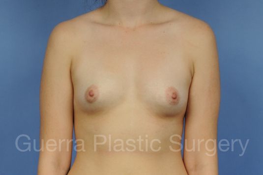 next Case #1002165 Before