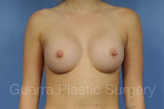 prev Case #1002164 After