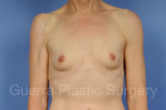 next Case #1002161 Before