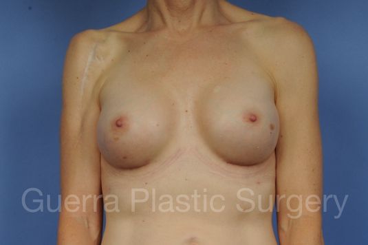 next Case #1002161 After