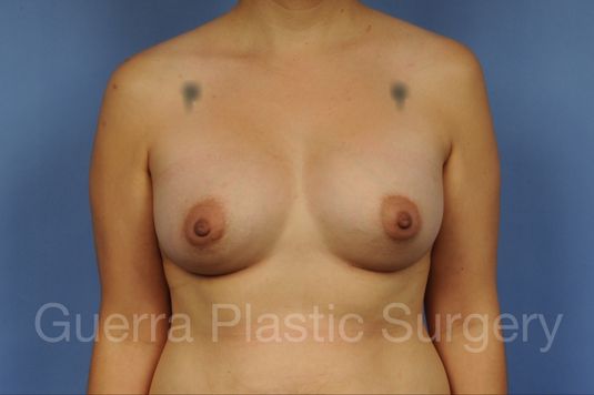 prev Case #1002160 After