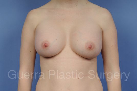 prev Case #1002174 After