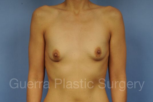 next Case #1002175 Before