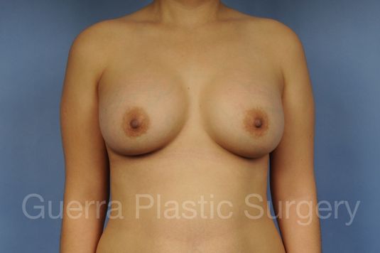 prev Case #1002179 After