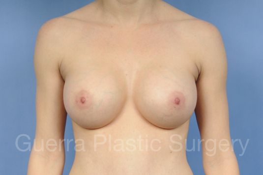 prev Case #1001175 After