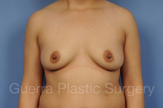 next Case #1001177 Before