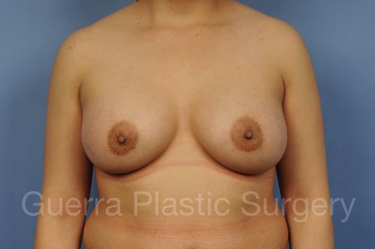 next Case #1001177 After