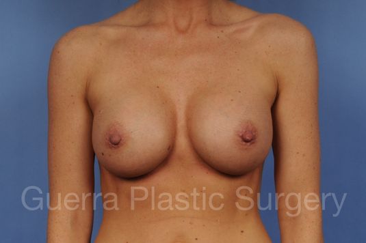 next Case #1001179 After