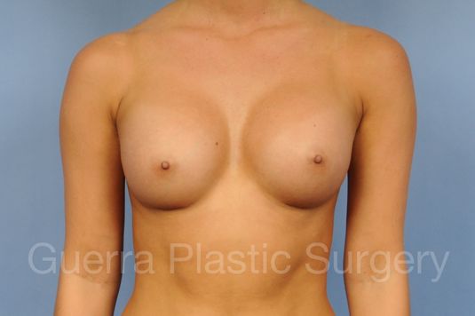 prev Case #1001182 After