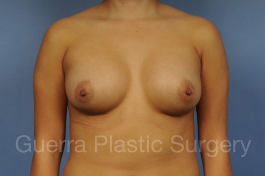 prev Case #10020171 After