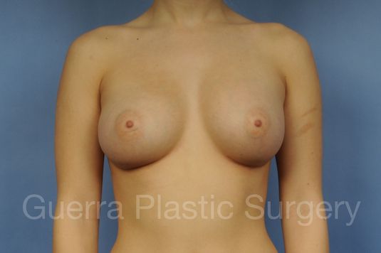 prev Case #1002170 After