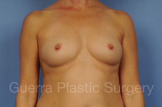 next Case #1002169 Before