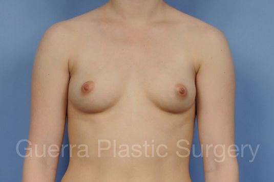 next Case #1002185 Before